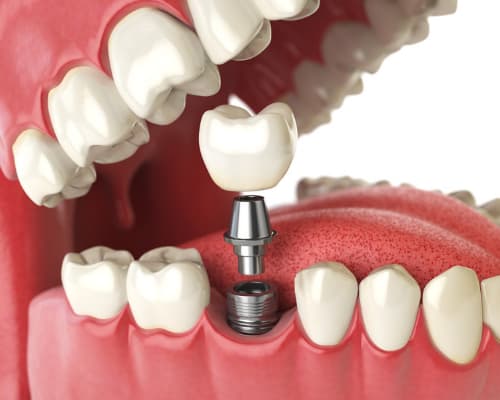 3D Graphic of dental implants close up