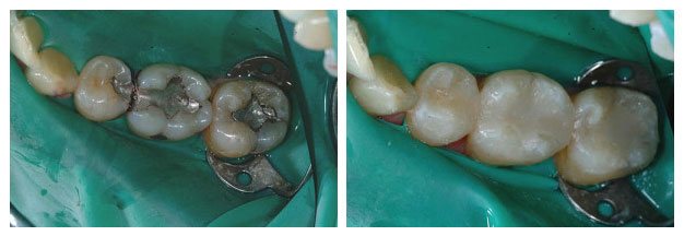 Before and after shot of dental crowns 