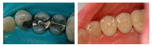 Before and after shot of dental fillings