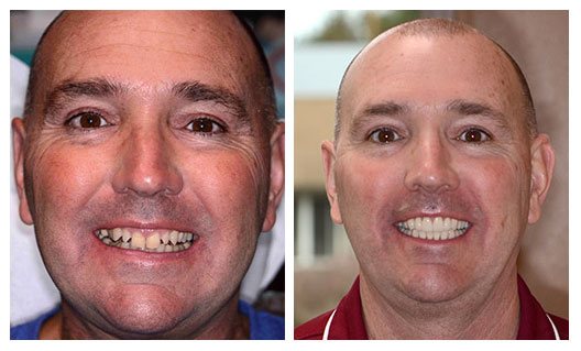 Before and after shot of man smiling