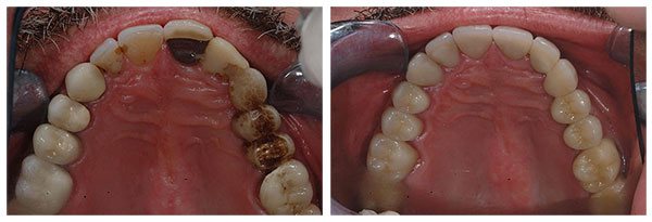 Before and after shot of denture treatment