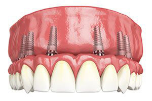 3D image of Dental Implants