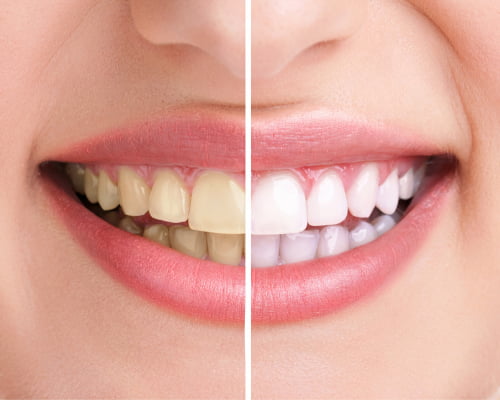 Before and after image of teeth whitening