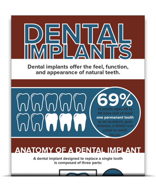 Dental Implants Free Ebook placeholder