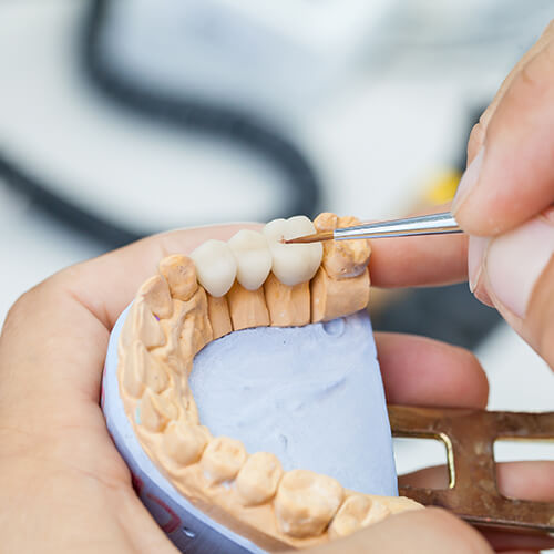 Close up of a dental bridge being crafted