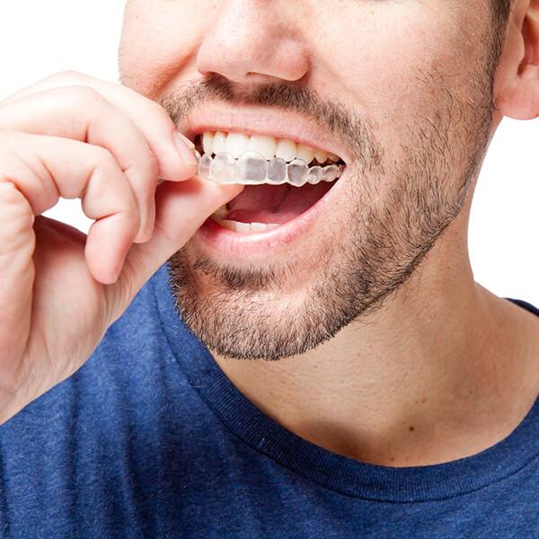A male is placing a clear aligner over his upper teeth.