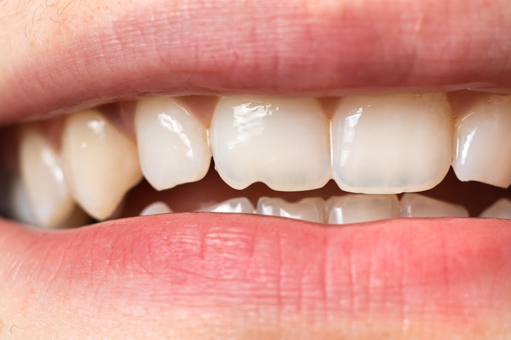 3 Cosmetic Procedures to Repair Tooth Grinding Damage